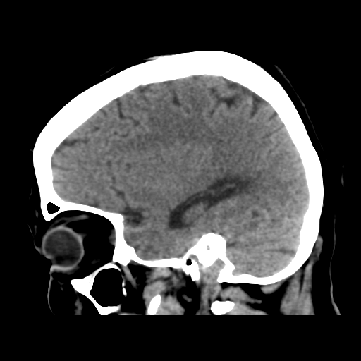 Cerebral metastasis to basal ganglia (Radiopaedia 81568-95412 E 43).png