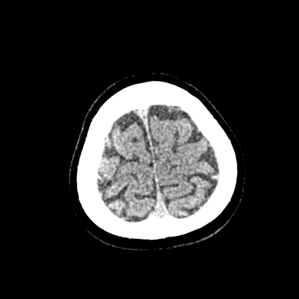 Cerebral ring enhancing lesions - cerebral metastases (Radiopaedia 44922-48818 Axial non-contrast 86).jpg