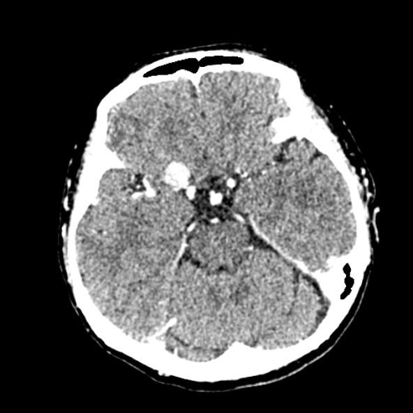 File:Cerebral ring enhancing lesions - cerebral metastases (Radiopaedia 44922-48818 B 104).jpg