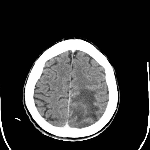 File:Cerebral toxoplasmosis (Radiopaedia 43956-47460 Axial C+ delayed 35).jpg