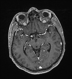 Cerebral toxoplasmosis (Radiopaedia 43956-47461 Axial T1 C+ 30).jpg