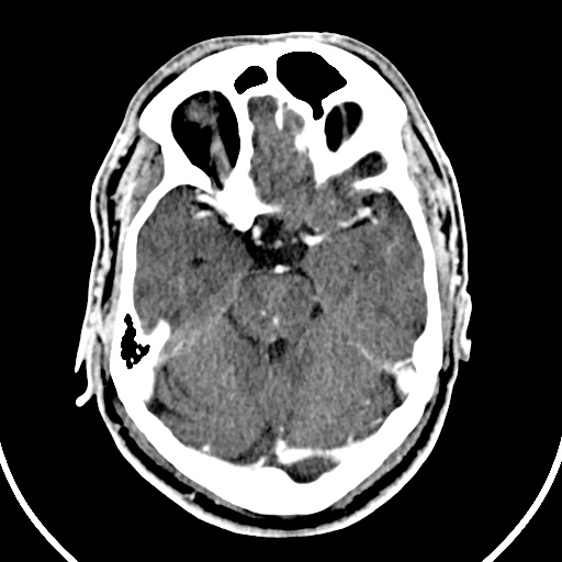 File:Cerebral venous angioma (Radiopaedia 69959-79977 B 22).jpg