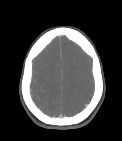File:Cerebral venous hemorrhagic infarction (Radiopaedia 38461-40550 Axial MIP VENOGRAM 41).png