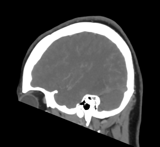 Cerebral venous infarction due to transverse sinus thrombosis (Radiopaedia 34688-36120 Sagittal CT venogram 16).png