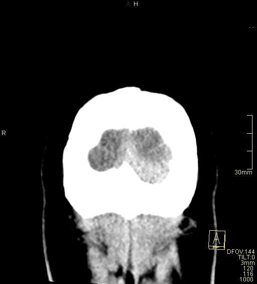 Cerebral venous sinus thrombosis (Radiopaedia 91329-108965 Coronal non-contrast 55).jpg