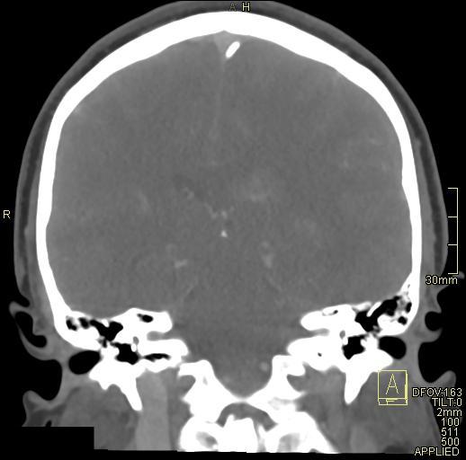 Cerebral venous sinus thrombosis (Radiopaedia 91329-108965 Coronal venogram 53).jpg