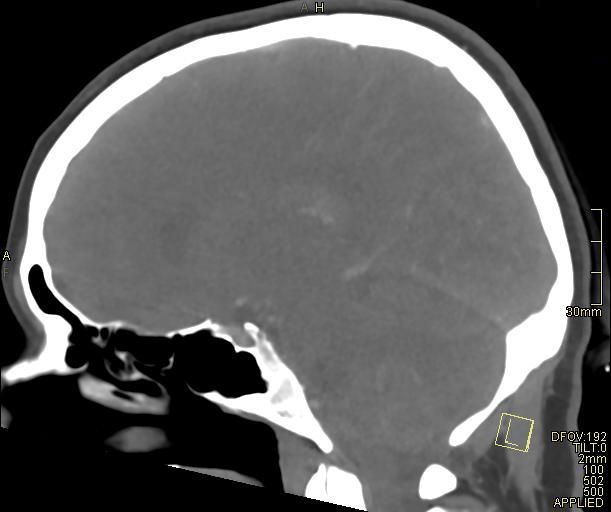 Cerebral venous sinus thrombosis (Radiopaedia 91329-108965 Sagittal venogram 42).jpg