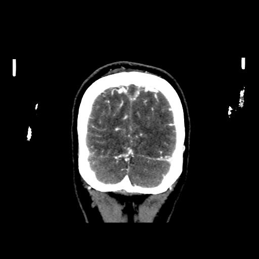 File:Cerebral venous throbmosis - hemorrhagic venous infarction (Radiopaedia 87318-103613 Coronal CT venogram 37).jpg