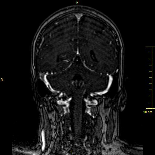 File:Cerebral venous thrombosis (Radiopaedia 23288-23351 MRV 114).JPG