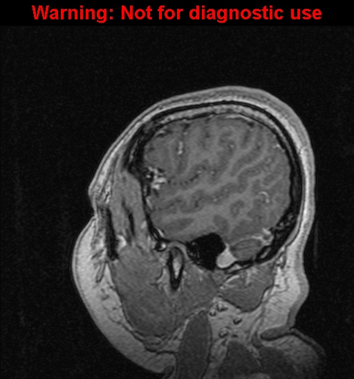 Cerebral venous thrombosis (Radiopaedia 37224-39208 Sagittal T1 C+ 128).jpg