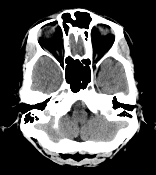 File:Cerebral venous thrombosis (Radiopaedia 38392-40467 Axial non-contrast 6).png