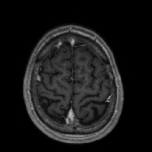 Cerebral venous thrombosis (Radiopaedia 38392-40469 Axial T1 C+ 67).png