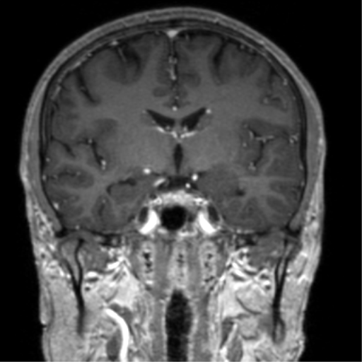 Cerebral venous thrombosis (Radiopaedia 38392-40469 Coronal T1 C+ 48).png