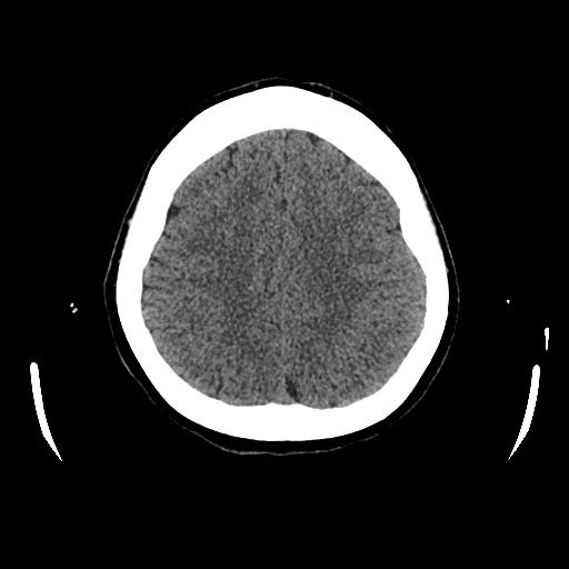 Cerebral venous thrombosis with venous hemorrhagic infarct (Radiopaedia 90354-107660 Axial non-contrast 38).jpg