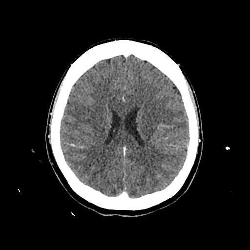 File:Cerebral venous thrombosis with venous hemorrhagic infarct (Radiopaedia 90354-107660 Axial with contrast 106).jpg
