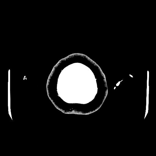 Cerebral venous thrombosis with venous hemorrhagic infarct (Radiopaedia 90354-107660 Axial with contrast 168).jpg