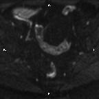File:Cervical adenocarcinoma (Radiopaedia 65011-73985 Axial DWI 62).jpg