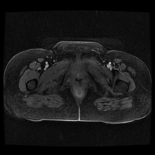 Cervical carcinoma (Radiopaedia 70924-81132 Axial T1 C+ fat sat 21).jpg