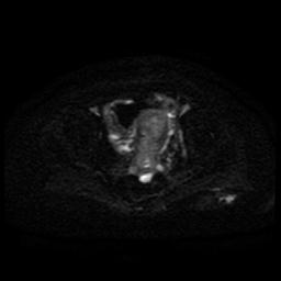 Cervical carcinoma (Radiopaedia 85405-101028 Axial DWI 30).jpg
