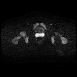 Cervical carcinoma (Radiopaedia 88010-104555 Axial DWI 44).jpg