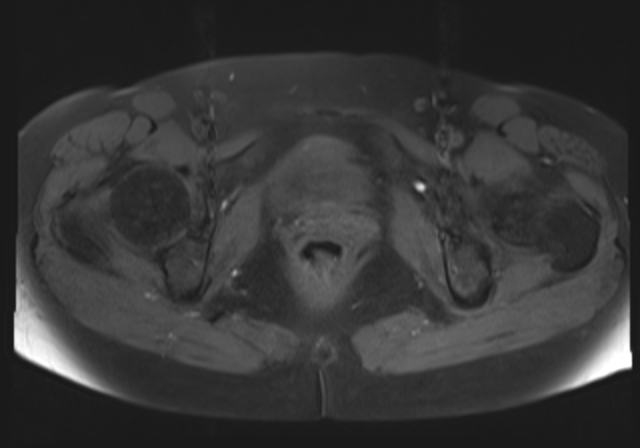 File:Cervical carcinoma (Radiopaedia 88312-104943 Axial T1 fat sat 17).jpg