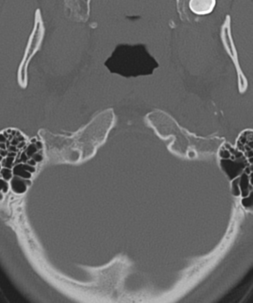 Cervical intercalary bone (Radiopaedia 35211-36748 Axial bone window 9).png
