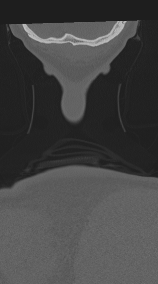 Cervical intercalary bone (Radiopaedia 35211-36748 Coronal bone window 86).png