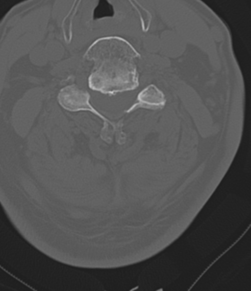 File:Cervical spine fracture in the setting of ankylosis (Radiopaedia 37038-38715 Axial bone window 32).png