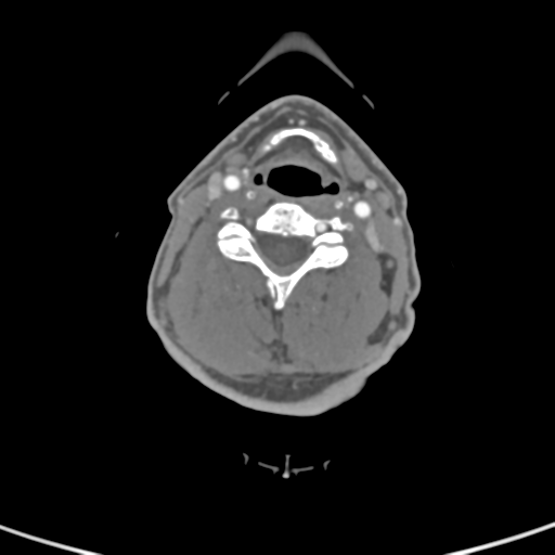 File:Cervical spine fractures with vertebral artery dissection (Radiopaedia 53296-59269 A 50).png