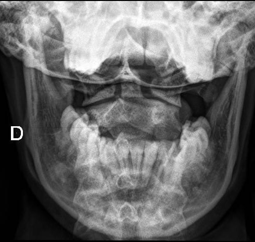 File:Cervical spine posterior ligamentous complex rupture (Radiopaedia 63486-72100 Transoral AP 1).jpg