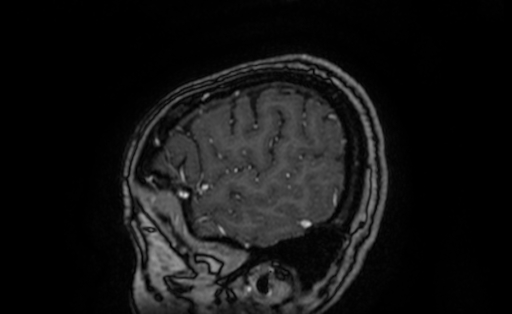 File:Cervical spondylodiscitis and calvarial hemangioma (Radiopaedia 64317-73103 Sagittal T1 C+ 8).jpg