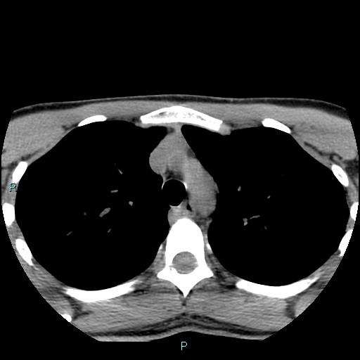 File:Cervical thymic cyst (Radiopaedia 88632-105335 Axial non-contrast 2).jpg