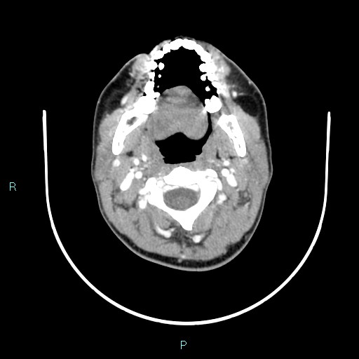 Cervical thymic cyst (Radiopaedia 88632-105335 B 85).jpg