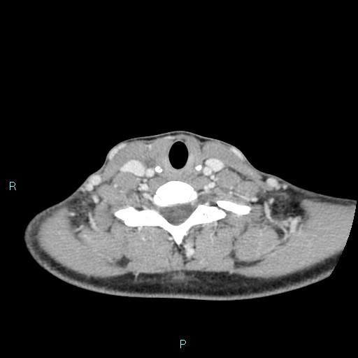 Cervical thymic cyst (Radiopaedia 88632-105335 C 43).jpg