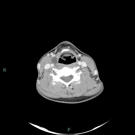 File:Cervical thymic cyst (Radiopaedia 88632-105335 C 56).jpg