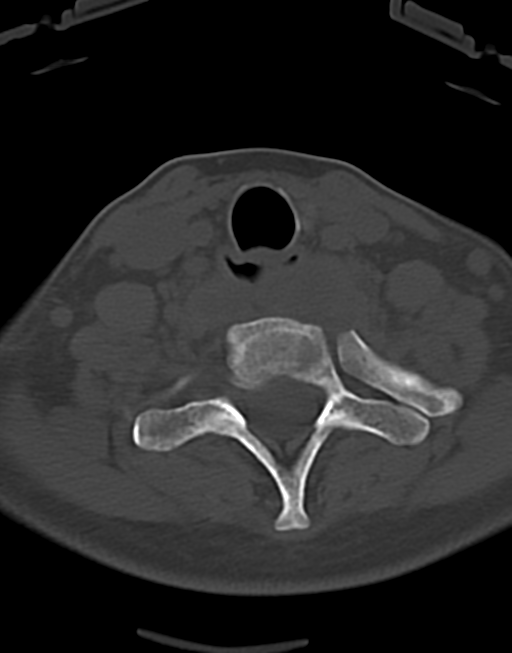 Cervical tuberculous spondylitis (Radiopaedia 39149-41365 Axial bone window 43).png