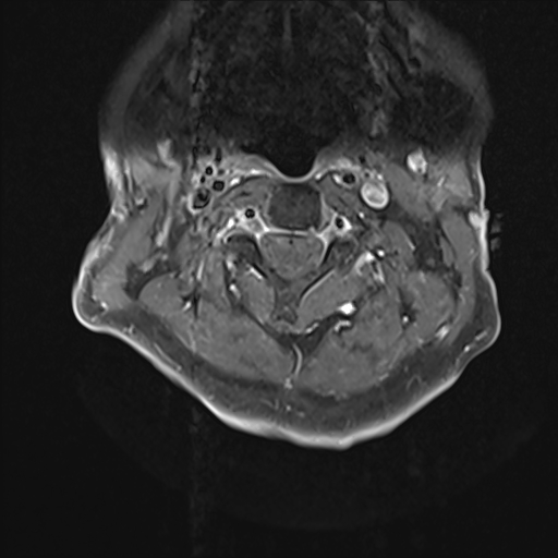 File:Cervical tumor-like myelopathy due to Type V dAVF (Radiopaedia 82461-96604 Axial T1 C+ fat sat 10).jpg