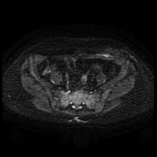 File:Cesarian section scar endometriosis (Radiopaedia 66520-75799 Axial DWI 30).jpg