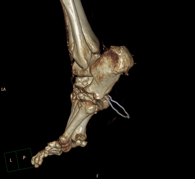 File:Charcot joint (Radiopaedia 36629-38194 3D bone window 9).jpg