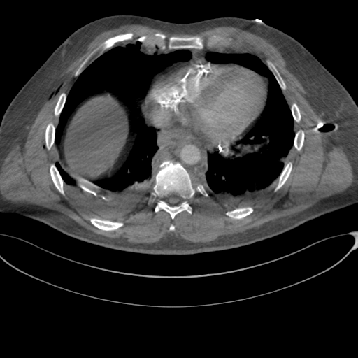 File:Chest multitrauma - aortic injury (Radiopaedia 34708-36147 A 206).png