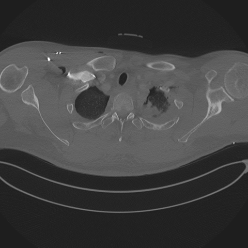 Chest multitrauma - aortic injury (Radiopaedia 34708-36147 Axial bone window 37).png