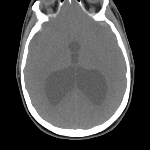 Chiari I malformation and obstructive hydrocephalus (Radiopaedia 41185-43981 D 11).png