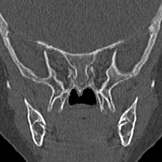 File:Choanal atresia (Radiopaedia 88525-105975 Coronal bone window 78).jpg