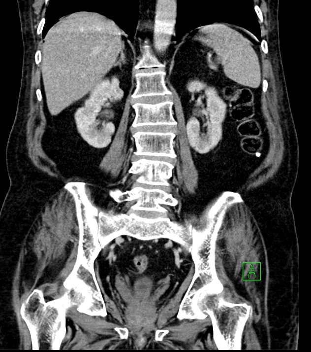Cholangiocarcinoma with cerebral metastases (Radiopaedia 83519-98629 G 54).jpg