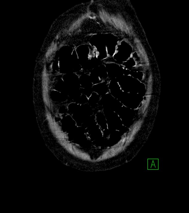 Cholangiocarcinoma with cerebral metastases (Radiopaedia 83519-98629 G 6).jpg