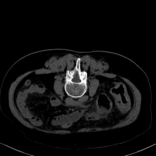 File:Cholecystitis - obstructive choledocholitiasis (CT intravenous cholangiography) (Radiopaedia 43966-47479 Axial 72).png