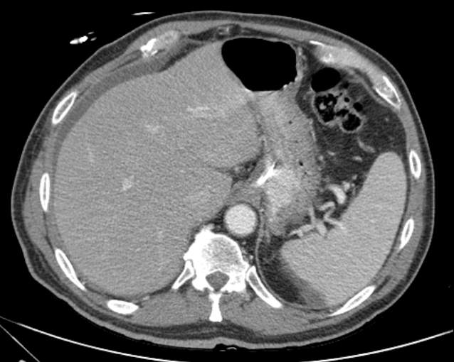 File:Cholecystitis - perforated gallbladder (Radiopaedia 57038-63916 A 18).jpg
