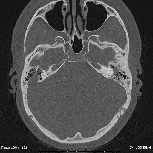 Cholesteatoma - external auditory canal (Radiopaedia 88452-105096 Axial bone window 63).jpg