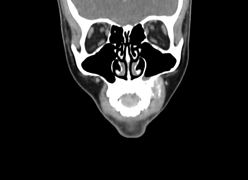 Chondroblastic osteosarcoma (Radiopaedia 67363-76741 D 25).jpg