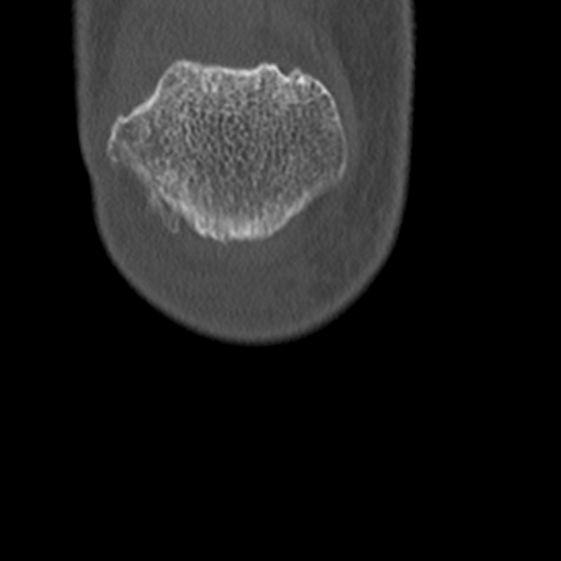 Chondrocalcinosis (Radiopaedia 16275-15955 Coronal bone window 6).jpg